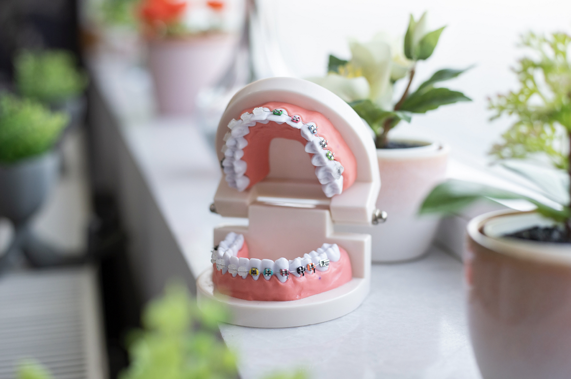 A cosmetically appealing orthodontic treatment option. 