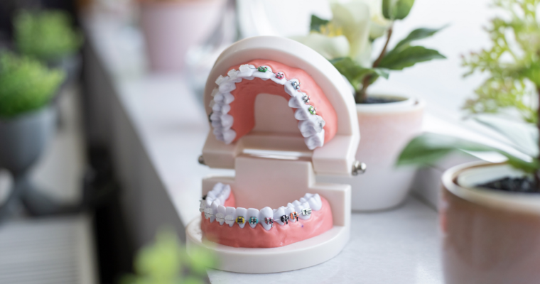 A cosmetically appealing orthodontic treatment option. 